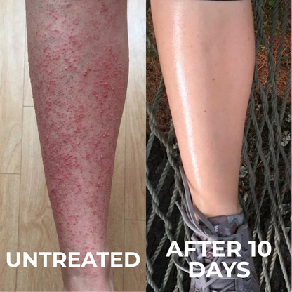 Advanced Triple-Acid Complex for Keratosis Pilaris